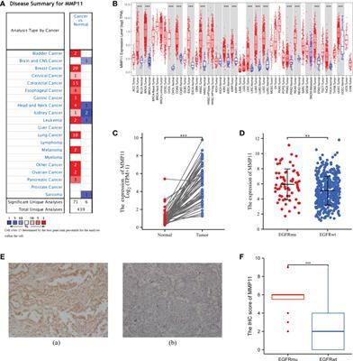 MMP11 is associated with the immune response and immune microenvironment in EGFR-mutant lung adenocarcinoma